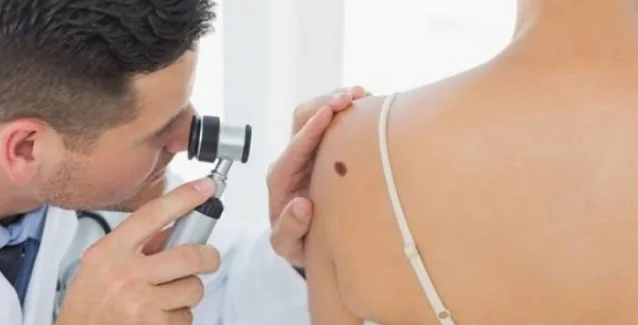 Δωρεάν εξετάσεις για τον Καρκίνο του Δέρματος
